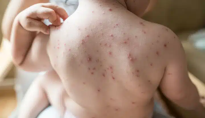 โรคอีสุกอีใส Chickenpox PAN Pcosmed ศูนย์รวมโซลูชั่นด้านผิวหนังครบวงจร