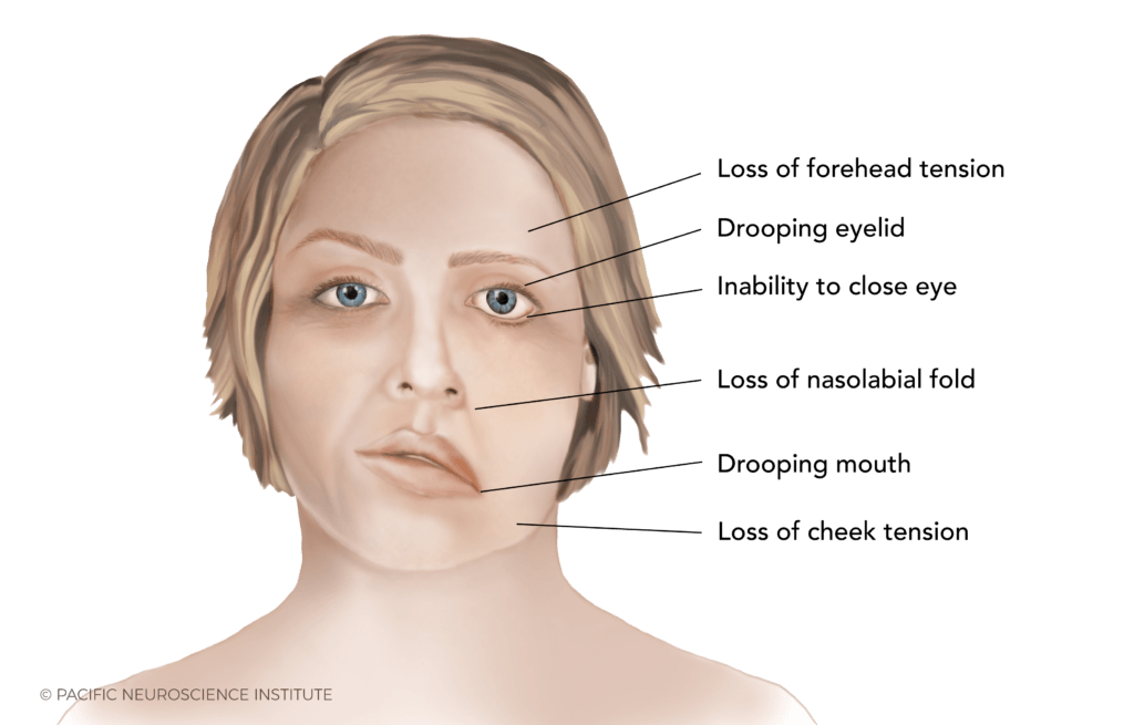 งูสวัด Shingles Ramsay Hunt Syndrome PAN Pcosmed ศูนย์รวมโซลูชั่นด้านผิวหนังครบวงจร