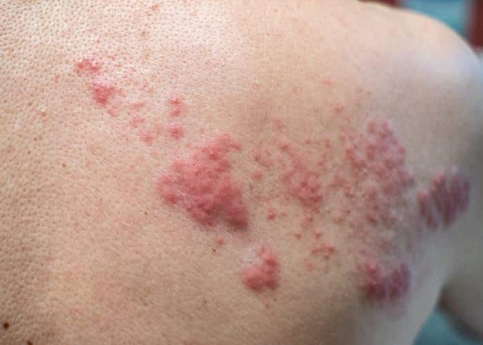 งูสวัด Shingles หรือ Herpes zoster PAN Pcosmed ศูนย์รวมโซลูชั่นด้านผิวหนังครบวงจร