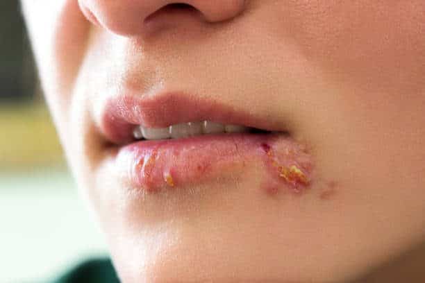 Herpes Simplex คือ เริม PAN Pcosmed ศูนย์รวมโซลูชั่นด้านผิวหนังครบวงจร