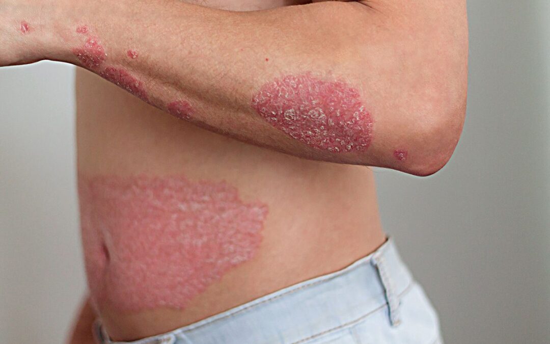 สะเก็ดเงิน (Psoriasis) มีอาการอย่างไร?