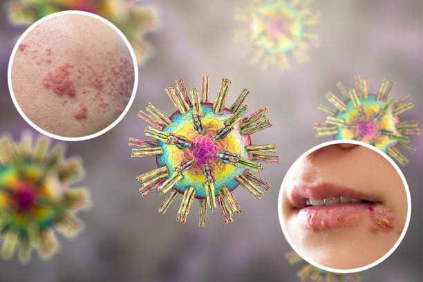 Herpes ในทางการแพทย์ หมายถึง เม็ด ตุ่ม กับ เม็ดกลุ่ม PAN Pcosmed ศูนย์รวมโซลูชั่นด้านผิวหนังครบวงจร