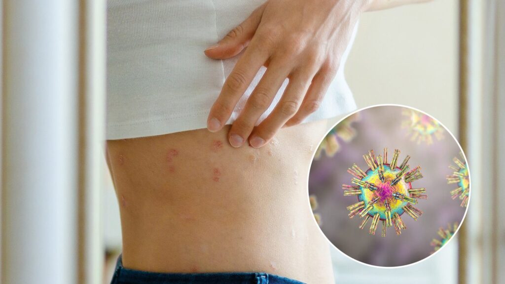 งูสวัด Shingles โรคผิวหนังชนิดหนึ่งที่เกิดจากเชื้อไวรัส Varicella Zoster Virus VZV PAN Pcosmed ศูนย์รวมโซลูชั่นด้านผิวหนังครบวงจร