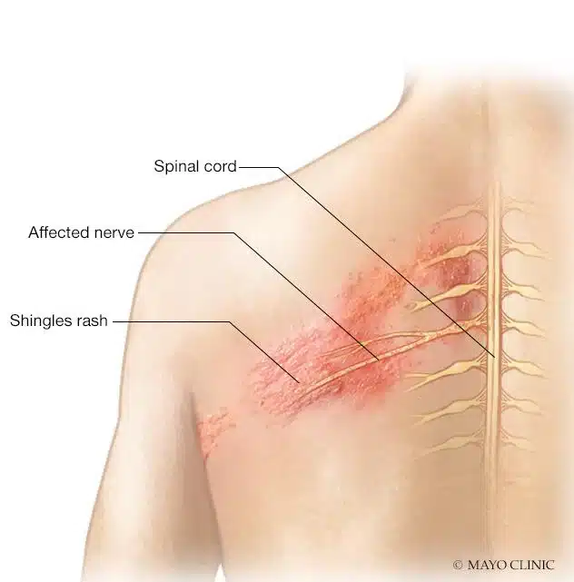 งูสวัด Shingles Shingles affects the nerves PAN Pcosmed ศูนย์รวมโซลูชั่นด้านผิวหนังครบวงจร