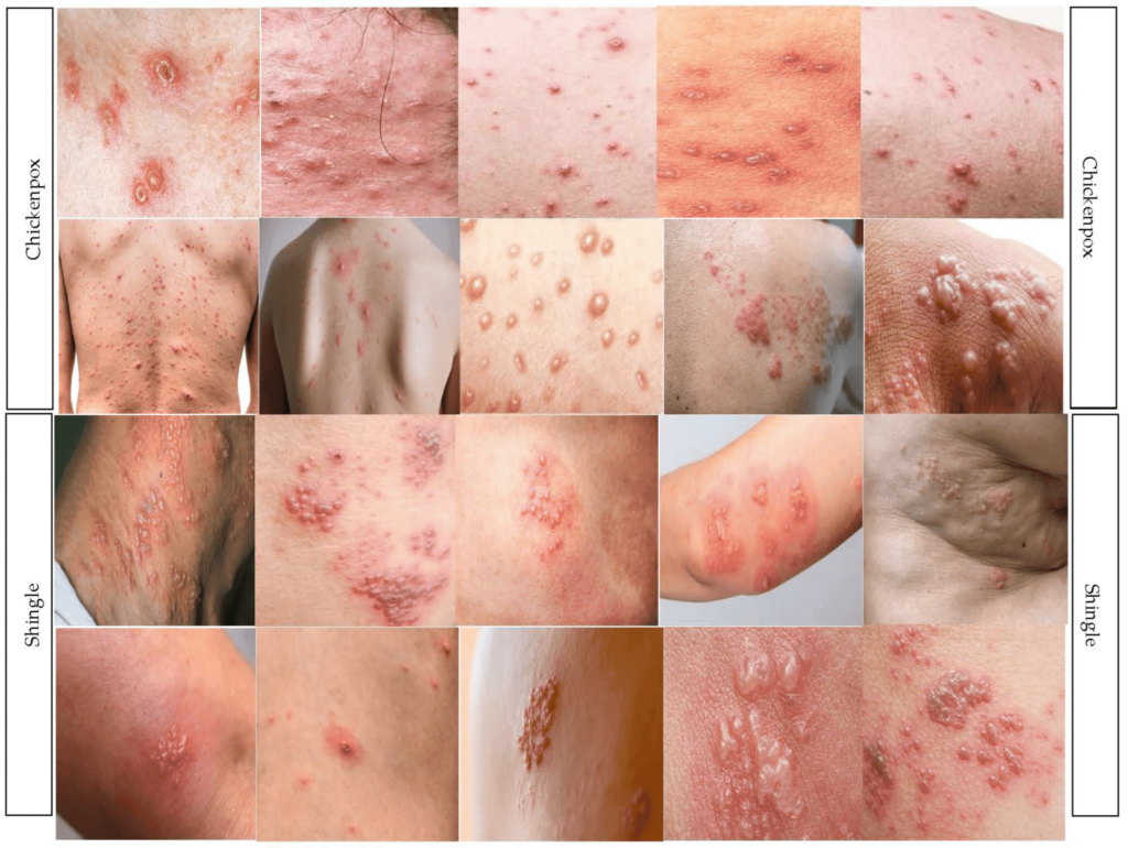 งูสวัด Shingles และ อีสุกอีใส Chickenpox PAN Pcosmed ศูนย์รวมโซลูชั่นด้านผิวหนังครบวงจร