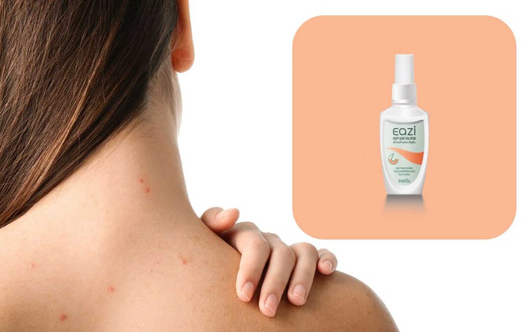 ลดปัญหาผื่นผิวกาย “สิวที่หลัง” ด้วย EAZI BODY ACNE SOLUTION