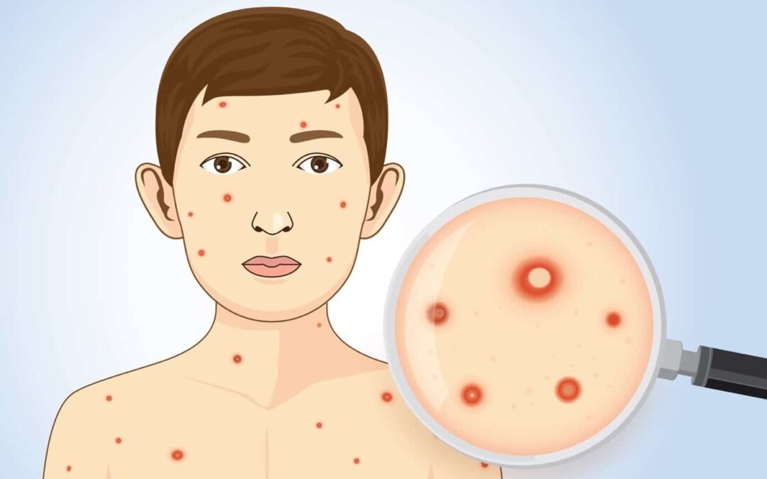 โรคอีสุกอีใส (Chickenpox) สาเหตุ อาการและวิธีรักษา