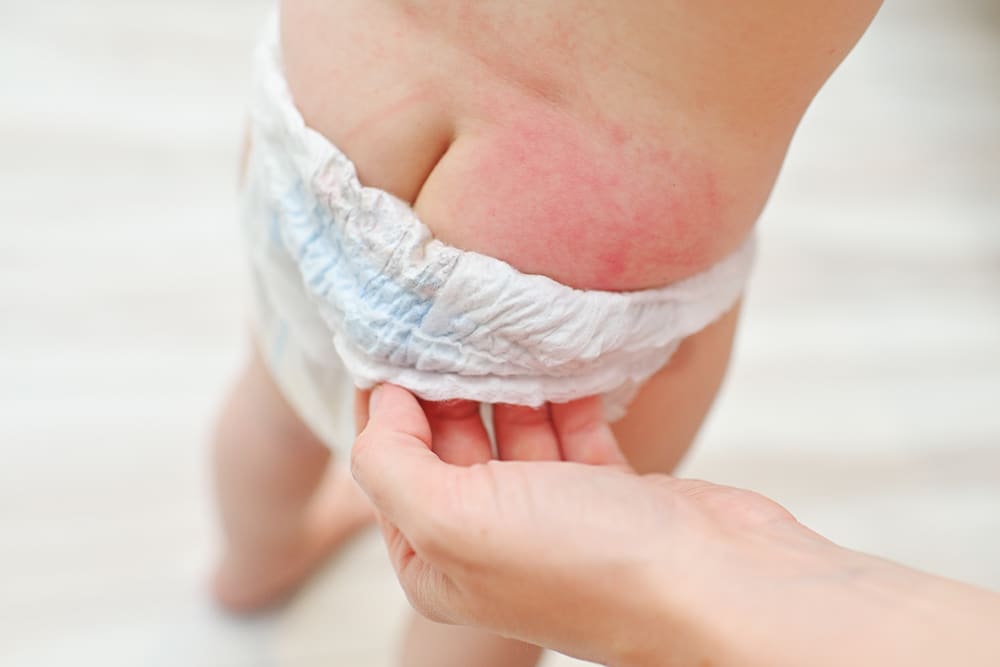 ผื่นผ้าอ้อม (Diaper Rash) คืออะไร รักษายังไง