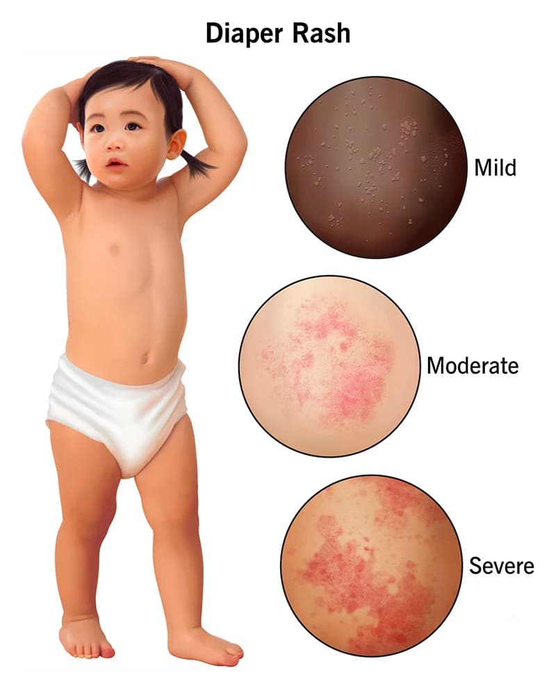 ผื่นผ้าอ้อมกัดในเด็กและผู้สูงวัย Diaper Rash PAN Pcosmed ศูนย์รวมโซลูชั่นด้านผิวหนังครบวงจร