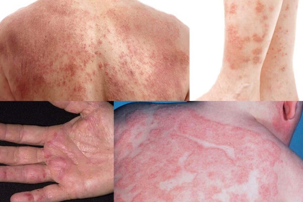 ผื่นภูมิแพ้ Atopic Dermatitis PAN Pcosmed ศูนย์รวมโซลูชั่นด้านผิวหนังครบวงจร