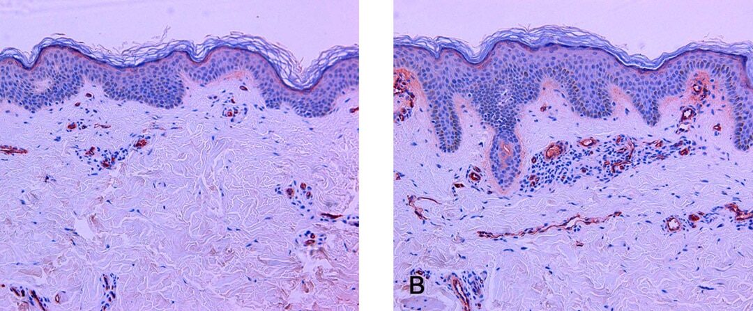 The vascular characteristics of melasma