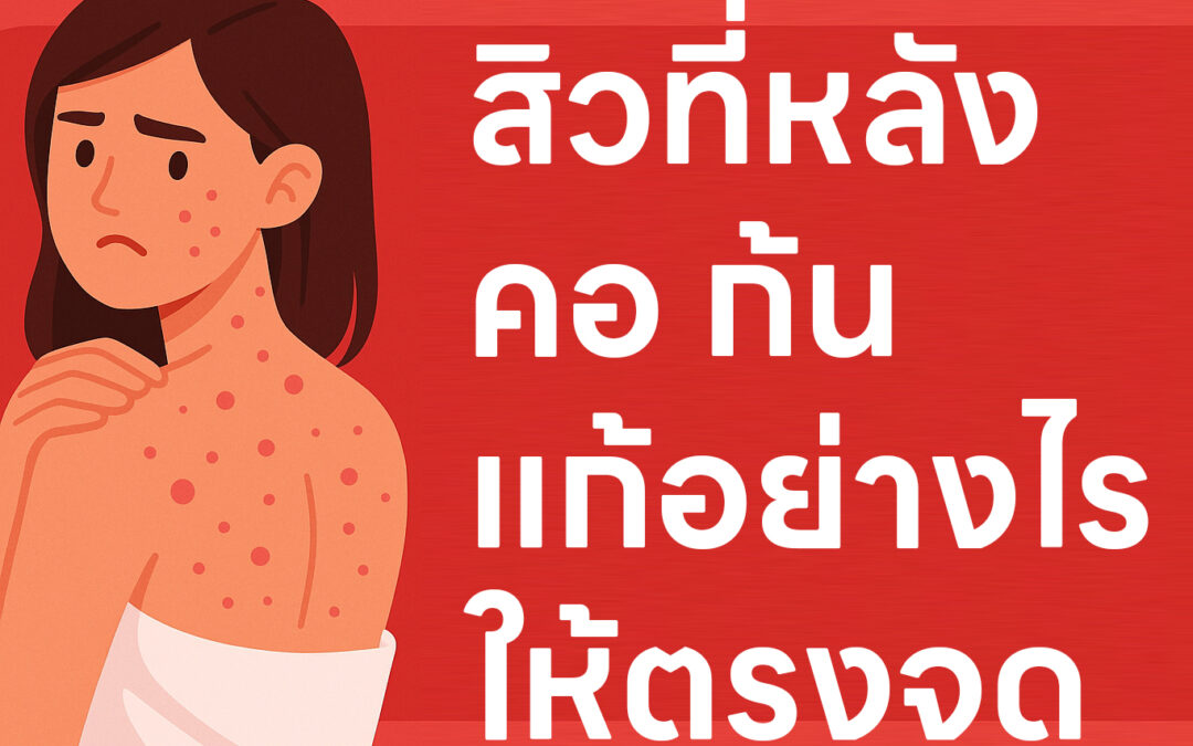 สิวที่หลัง คอ ก้น แก้อย่างไรให้ตรงจุด